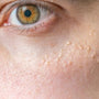 Let’s Talk Milia: What Are They & How To Prevent Them
