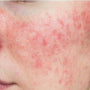 Covering Rosacea With Makeup: Get That Flawless Look Back