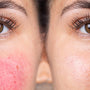 What's the Best Foundation for Covering Rosacea?